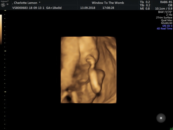 Had a 3D scan today