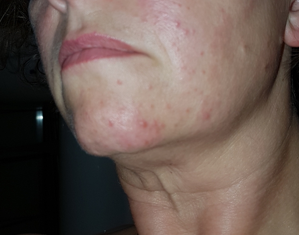 Anyone want to look at a photo of my spots and advise me?