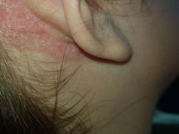 AIBU to feel like I have the ear problem of a small child at 30! Warning tmi photo included