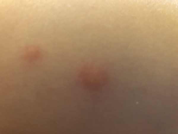 Eek! What are these bites on ds?