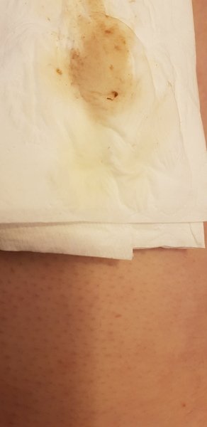 Discharge thoughts please?