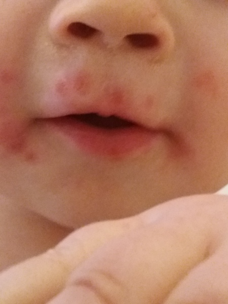 Is this chicken pox?