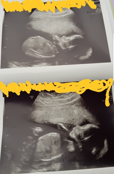 Just for fun! 20 week scan prediction.