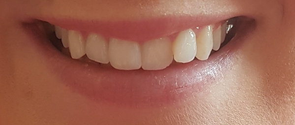 So unhappy with my smile - any dentists or orthodontists about? Photos attached
