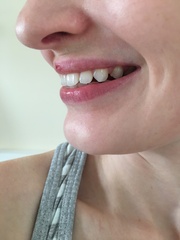 So unhappy with my smile - any dentists or orthodontists about? Photos attached