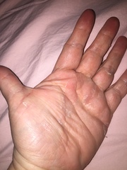 Peeling palms