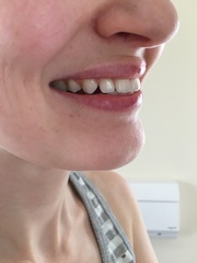 So unhappy with my smile - any dentists or orthodontists about? Photos attached