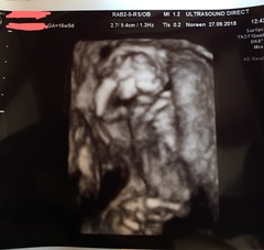 Anyone else have a weird looking 3D scan?