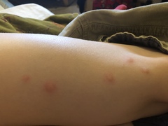 Eek! What are these bites on ds?