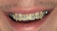 17 year old DS wants a better smile - any dentists on here?