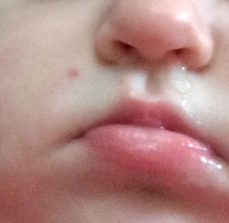 Is this hand, foot and mouth chickenpox, or something else?