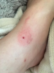 What has bitten me?