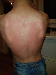 Potential peanut allergy? 8 year old.