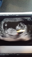 12 week scan