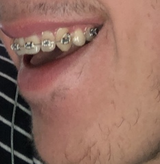17 year old DS wants a better smile - any dentists on here?