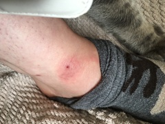 What has bitten me?