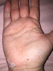 Peeling palms