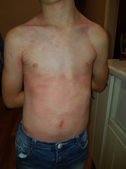 Potential peanut allergy? 8 year old.