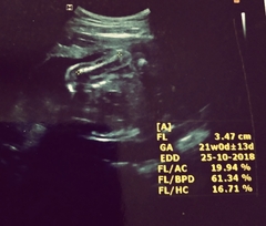 here is my 22 weeks 3 days twins scan.Please guess the gender from scan
