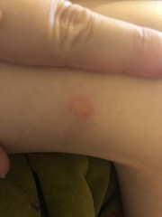 Eek! What are these bites on ds?