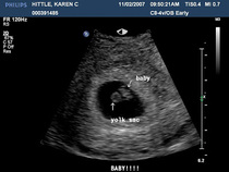 AIBU to think I'm 39 weeks not 35?