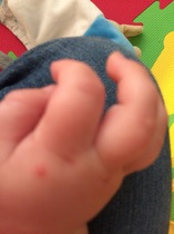 Is this hand, foot and mouth chickenpox, or something else?