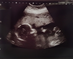 More Christmas Cake! Pregnancy after loss (thread 3)