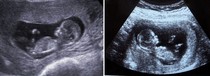 AIBU to think I'm 39 weeks not 35?