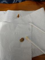 ****Klaxon**** DH's Earwax.  With Pics!