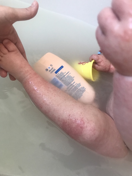 Hand foot and mouth, on bum?