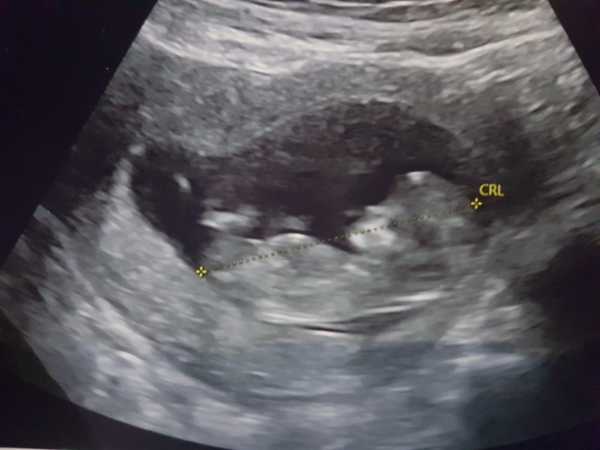 Can't stop crying - baby measuring 8 weeks at 12