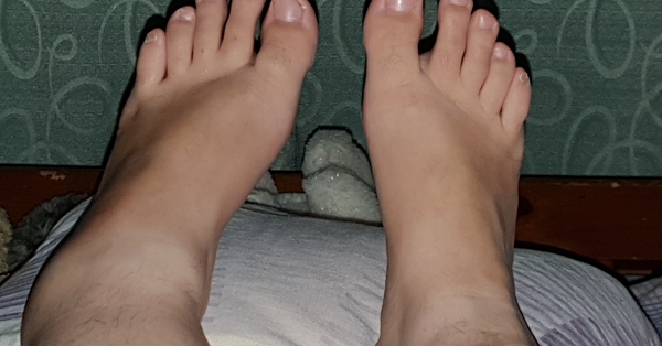 Broken ankle treatment