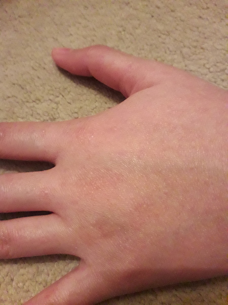 Scabies or allergic reaction?