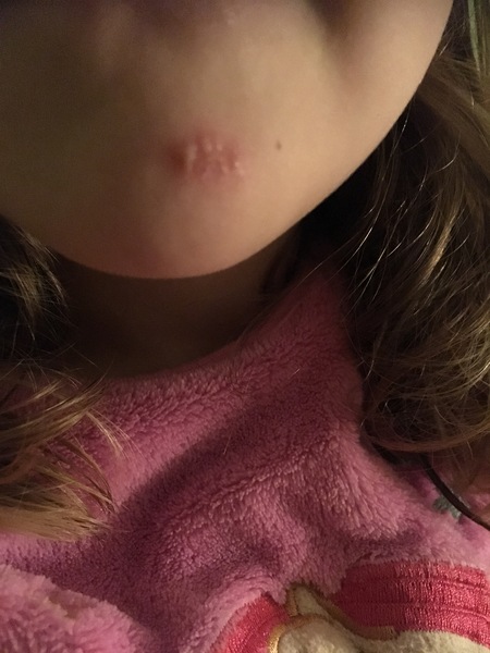 Is this Impetigo?
