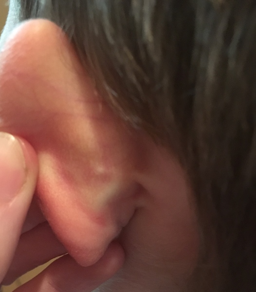 Tiny bump on back of ears