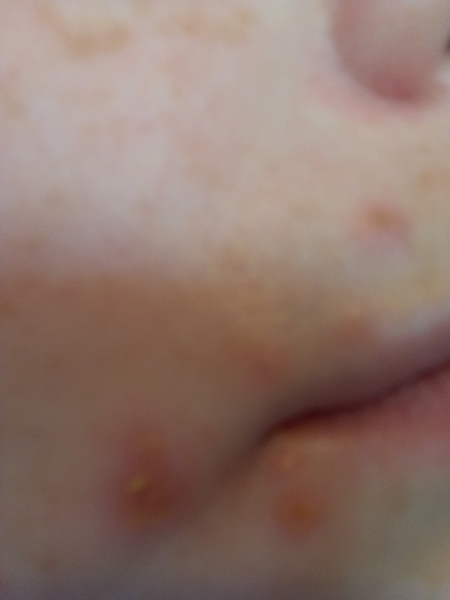 Anyone had hand foot and mouth as an adult?
