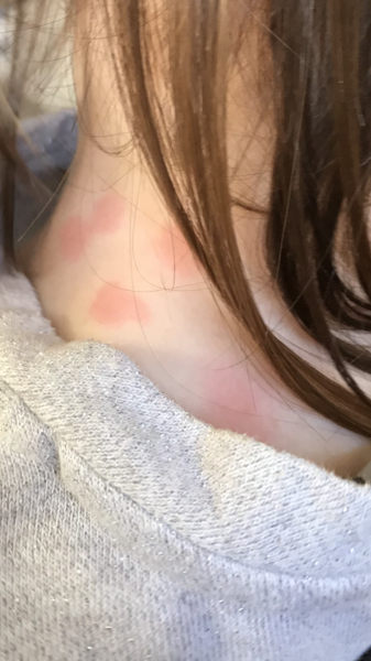 What is this rash? (Photo)