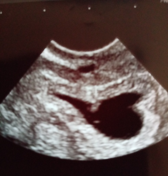 TTC after pregnancy loss - thread 26 - BFPs are coming!