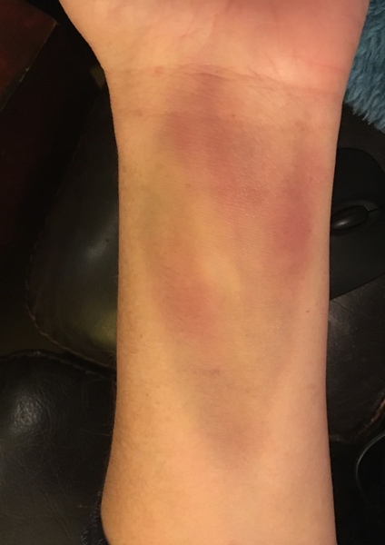 Today’s mystery, what have I done to my wrist?