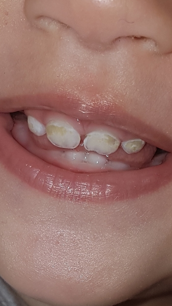 Decay or fluorosis any dentists??