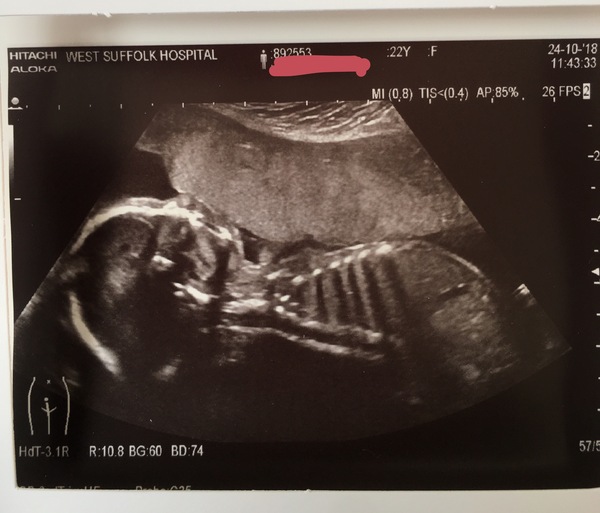 More Christmas Cake! Pregnancy after loss (thread 3)