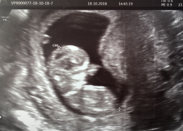 12 weeks and bleeding ...