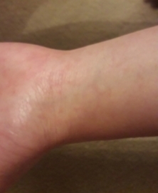 Scabies?  Allergic reaction?  Help pls.
