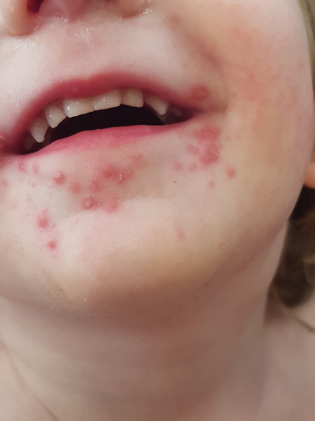 What's this rash (pic)