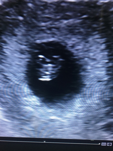 Pregnancy after loss: spring 2019 edition (The Brexit Babes) 🐧