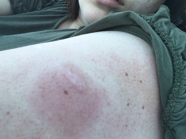 Flu jab side effects