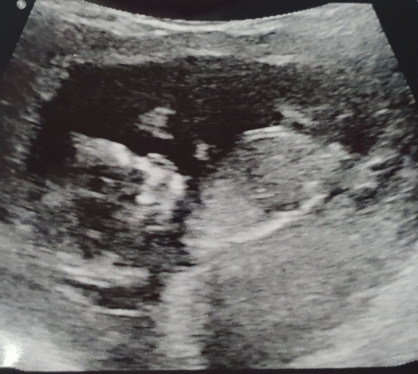 13 weeks pregnant and Consultant appointment.