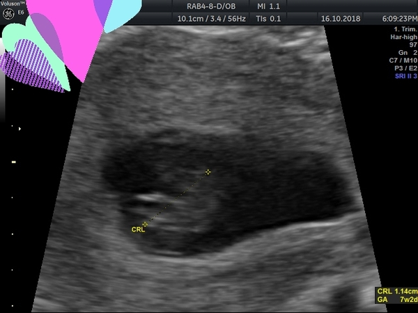 scan at 7 weeks 2 days.