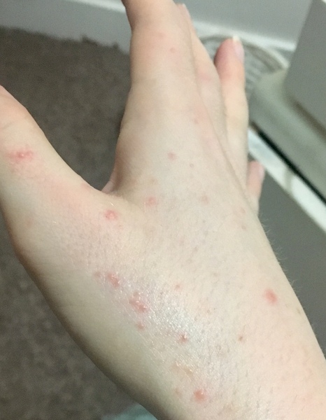 To ask you to help me work out what this rash is?
