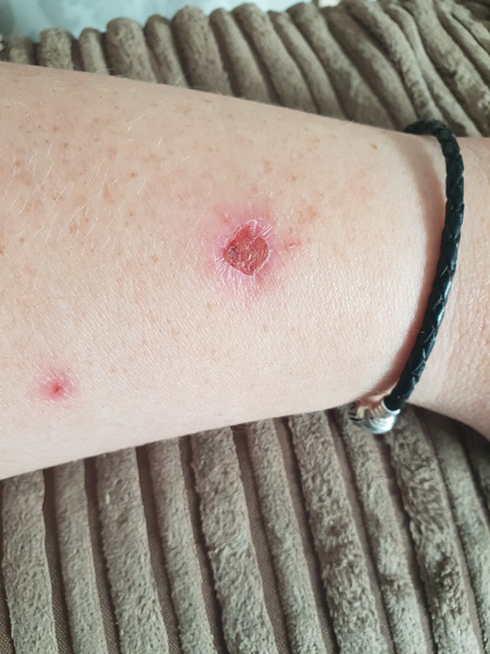 Does anyone else struggle to leave a scab alone?